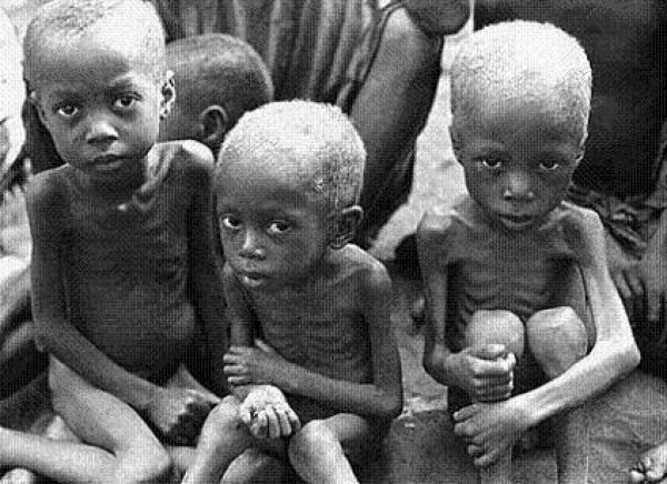 Image result for malnourished children image