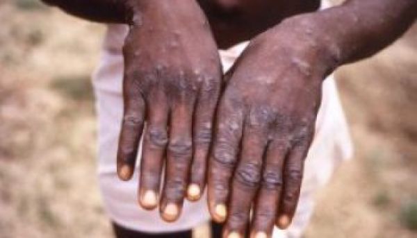 •hands afflicted with monkeypox virus