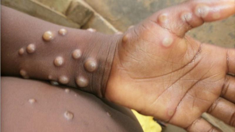 Cross River, Lagos lead as Mpox spreads to 63 LGs