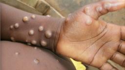 Cross River, Lagos lead as Mpox spreads to 63 LGs