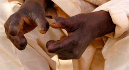 Rights group raises alarm over 3,000 leprosy patients left without access to drugs 