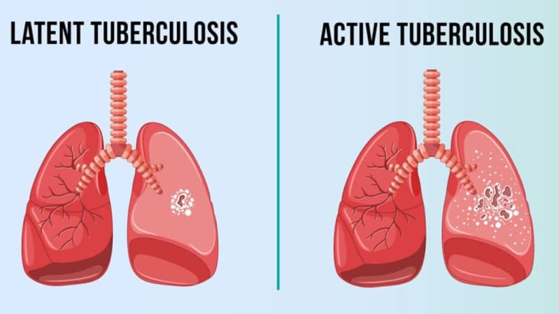  Tuberculosis kills 35 in Nasarawa