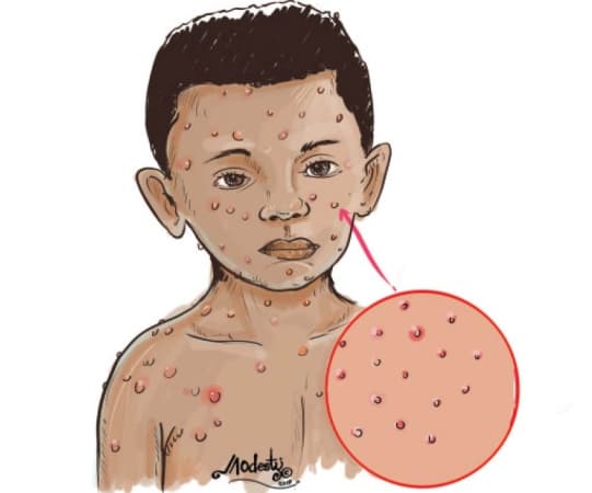 We’ve lost 5 children to measles outbreak, Kaduna village head laments