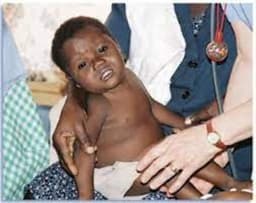 150,000 Nigerian children born with sickle cell gene annually — FG