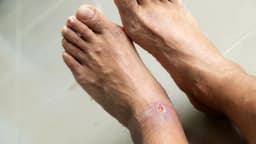 Avoid walking barefoot if you have diabetes — Expert