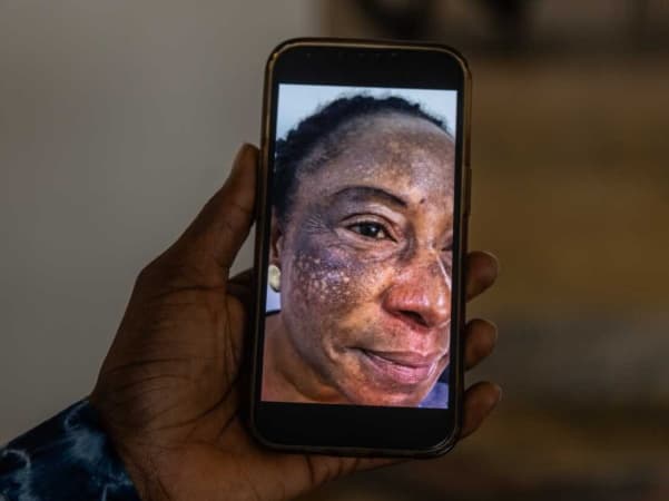Dermatologists warn Nigerians against skin bleaching