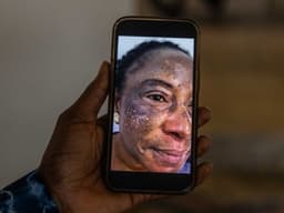 Dermatologists warn Nigerians against skin bleaching