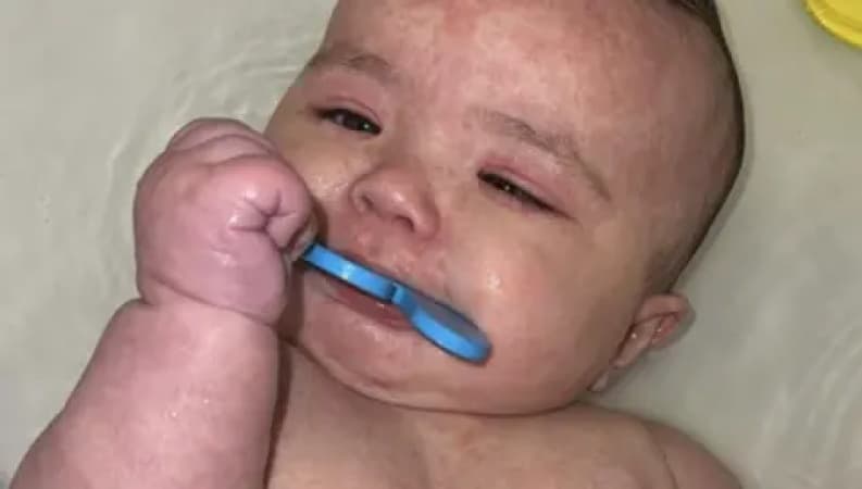 How Canada became the centre of a measles outbreak in North America