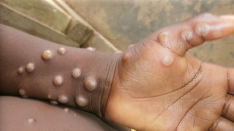 Benue records 31 suspected cases of Mpox in 5 LGAs
