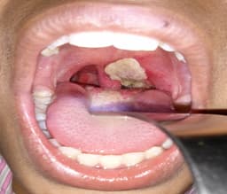 Diphtheria outbreak claims 10 lives in Niger State