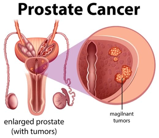 Prostate cancer: 5 early symptoms men shouldn’t ignore