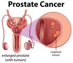 Prostate cancer: 5 early symptoms men shouldn’t ignore