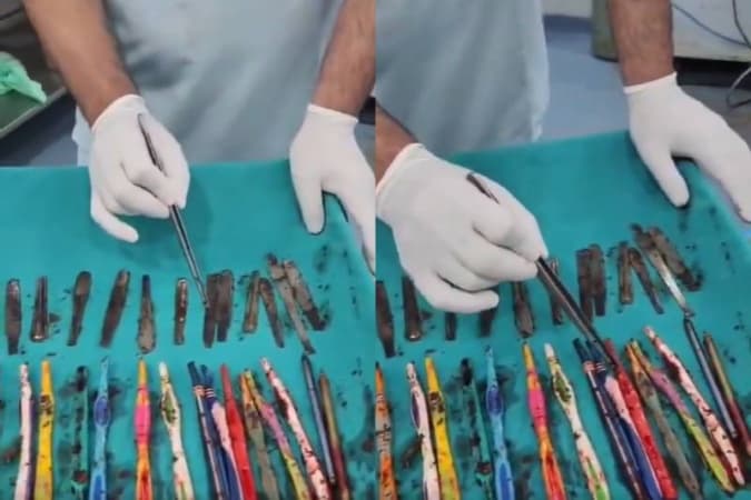 Doctors remove 29 spoons, 19 toothbrushes, and pens from man’s stomach