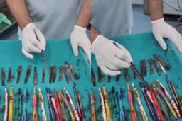 Doctors remove 29 spoons, 19 toothbrushes, and pens from man’s stomach