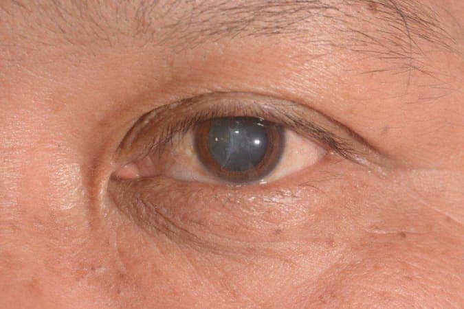 Over 94 million people battle cataract globally, five key facts to know