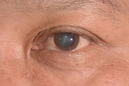 Over 94 million people battle cataract globally, five key facts to know