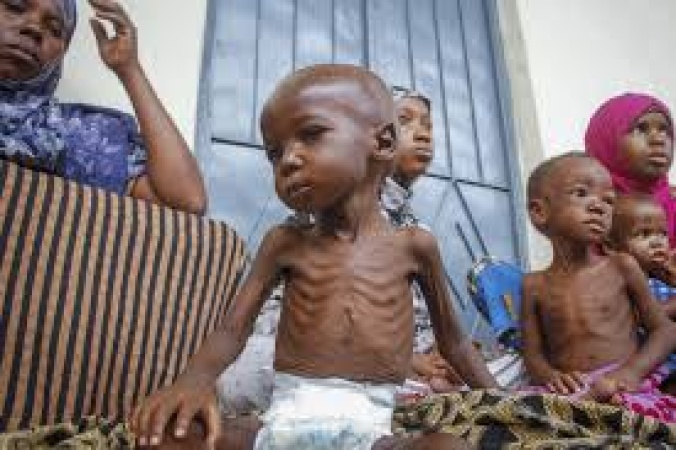 469 Kano children die of malnutrition in 6 months