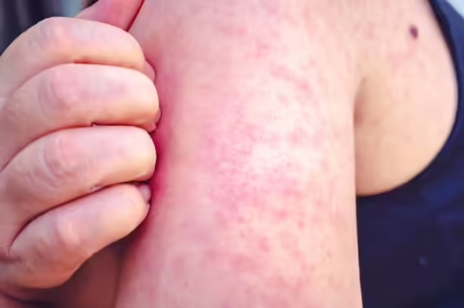 U.S. state South Carolina reports at least 88 new measles cases