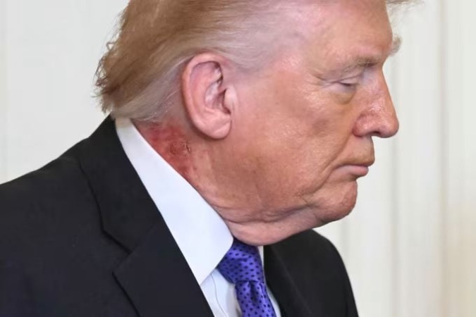 US: Trump’s doctor reveals reason behind rash on the president’s neck