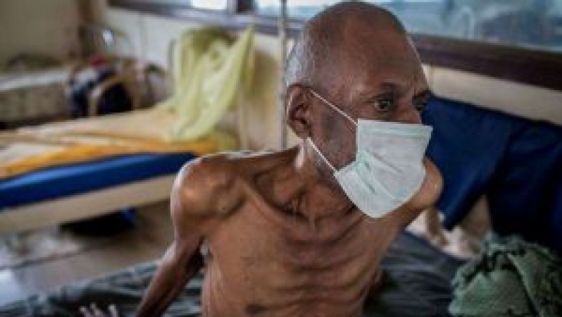 WHO urges action to end TB in Africa by 2030