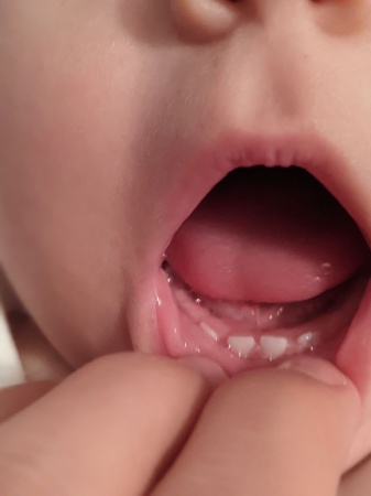 Teething not cause of stooling in infants — Experts debunk myth