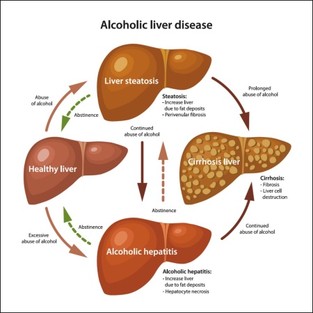Occasional heavy drinking poses major risk to liver — Study