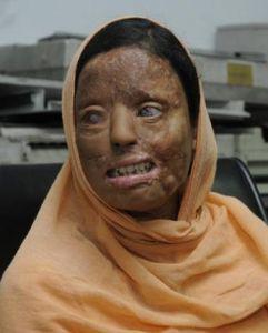 Acid attack victim wins â€œWho Wants To Be A Millionaireâ€