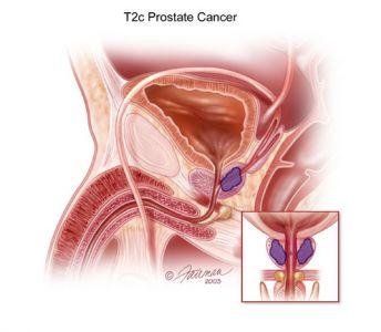 Regular sex prevents prostate cancer â€“ Medical Expert