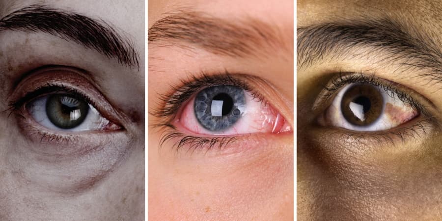 What the colour of your eyes says about your health