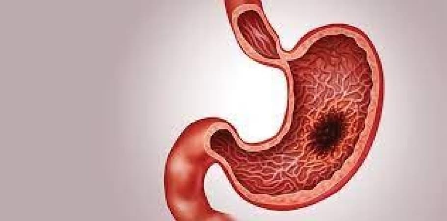 How to manage, prevent stomach cancer — Medical experts