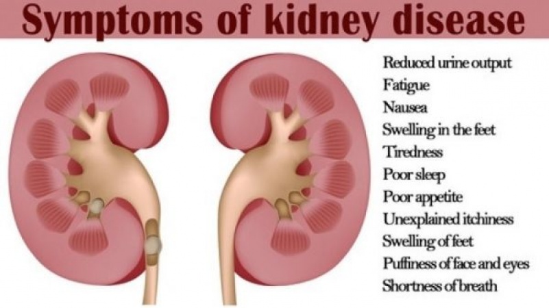 20m Nigerians Have Kidney Diseases Nephrologists News Express Nigeria